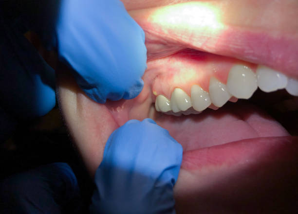 Best Dentist for Tooth Abscess  in Marriott Slaterville, UT